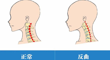 “颈椎曲度变直”怎么办？