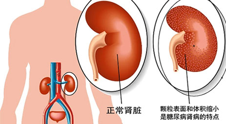 注意！糖尿病超5年要防肾病