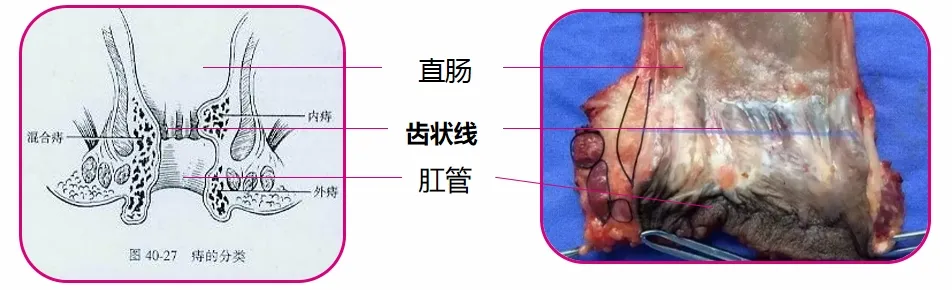 我不抽烟不喝酒不熬夜没有不良生活习惯，为什么还会得痔疮?
