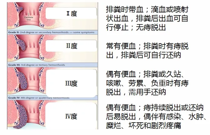 有“痔”不在年高?20岁就长痔疮?所有人注意：这5个错误的习惯正在“爆菊” !